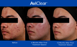 AviClear-Before-and-After-Template_12-month_2