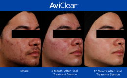 AviClear-Before-and-After-_12-month_1