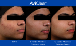 AviClear-Before-and-After-_12-month_3