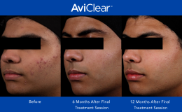 AviClear-Before-and-After-_12-month_4