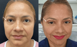 9-8-24-blepharoplasty