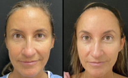 blepharoplasty-new-8-1
