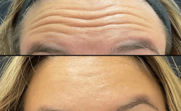 12-8-24-botox-new