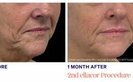 Gorodisky-Female-Side-1