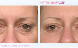 Emface_PIC_Ba-card-female-eyes-160_ENUS100