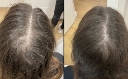 hair-loss-1-13-5-25