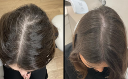 hair-loss-13-5-25