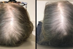 hair-restoration