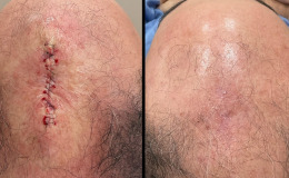 Mohs-surgery-1-13-5-25