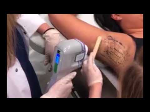 miraDry for permanent treatment of underarm sweat and odor