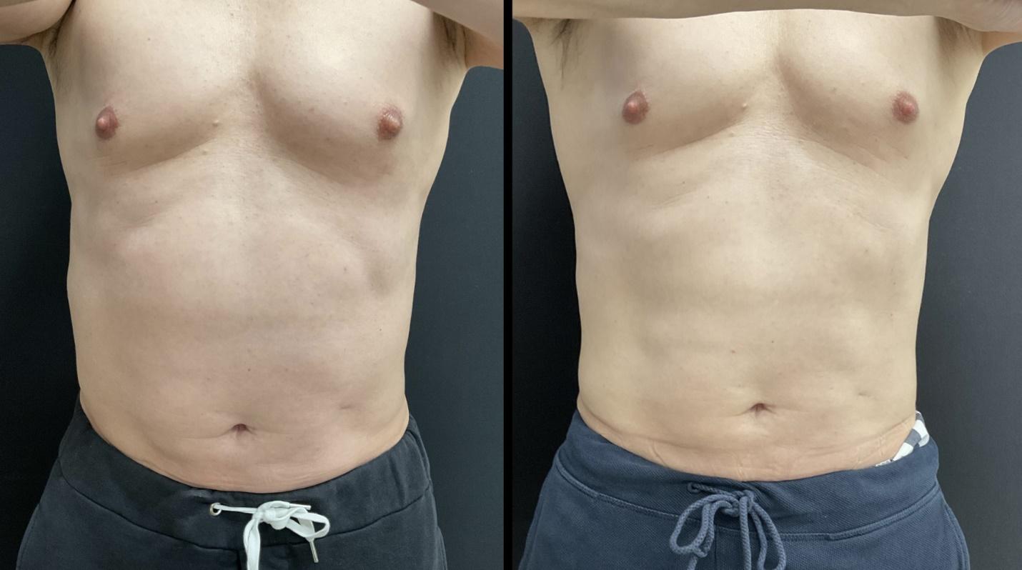 A comparison of a person's torso

Description automatically generated