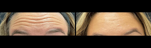 Real BOTOX in NYC Patient
