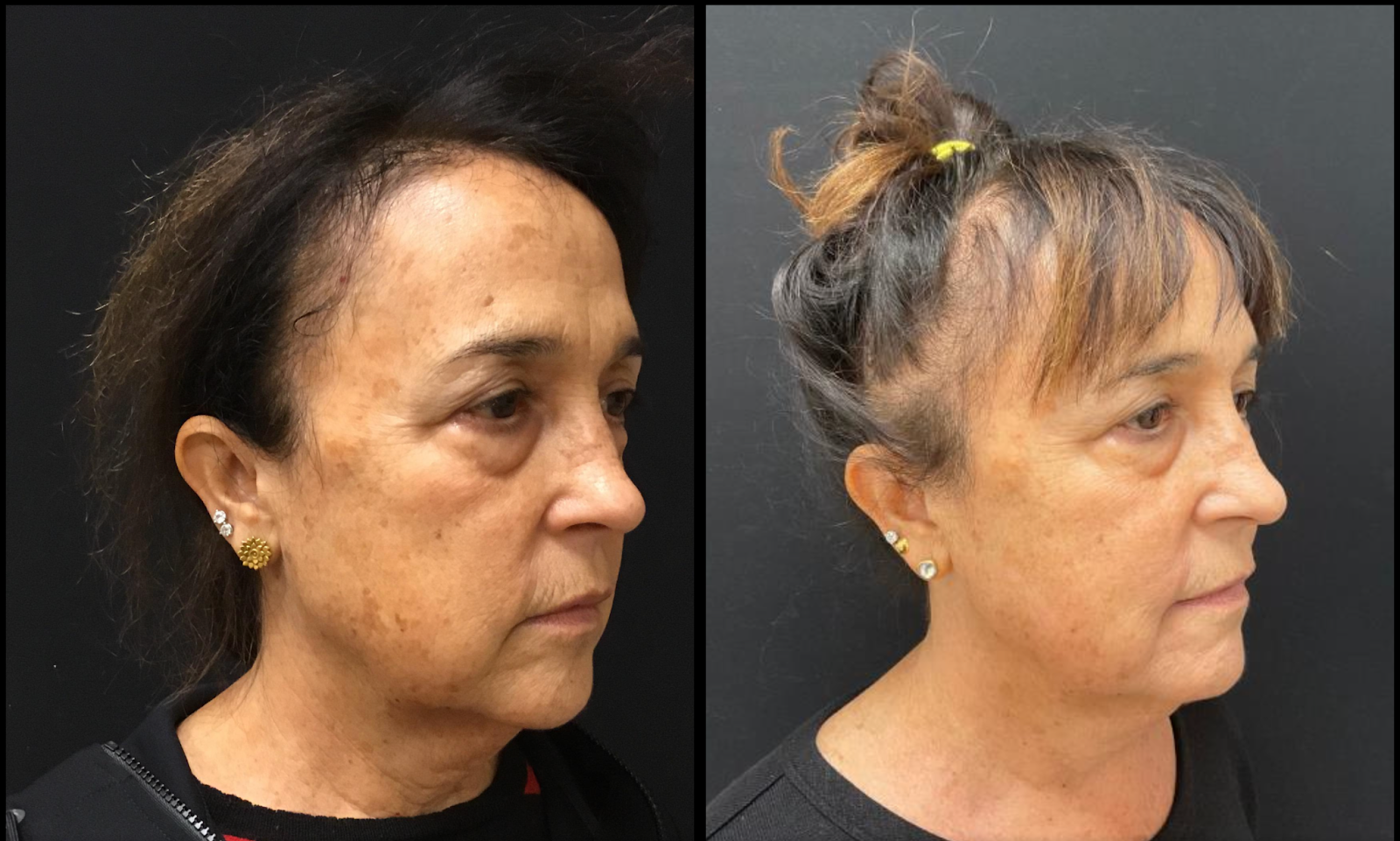 Understanding Hyperpigmentation Causes And Treatment Options Dr