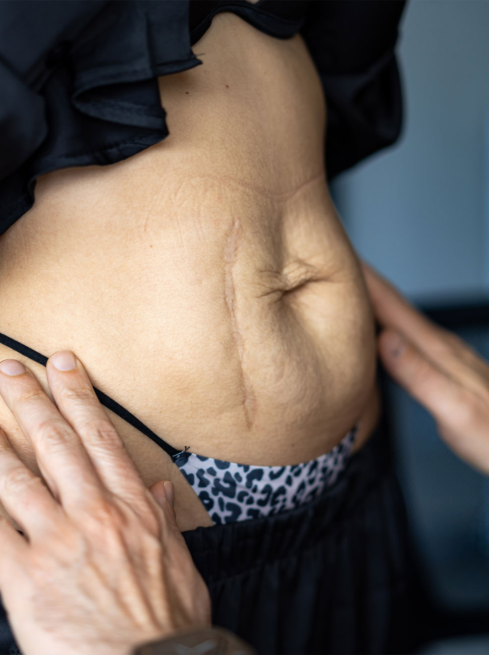 Ellacor loose skin weight loss