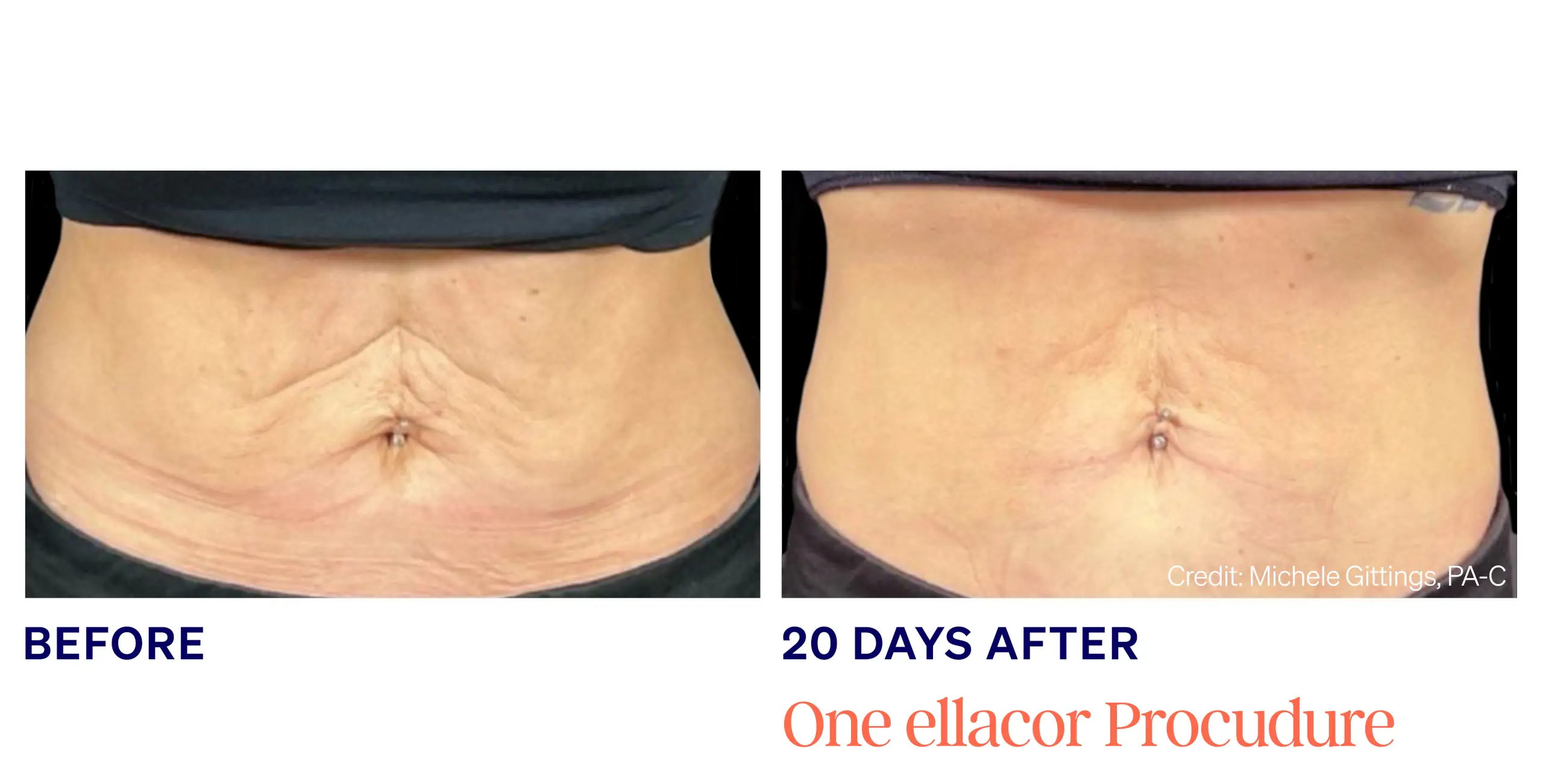 Ellecor Before After image